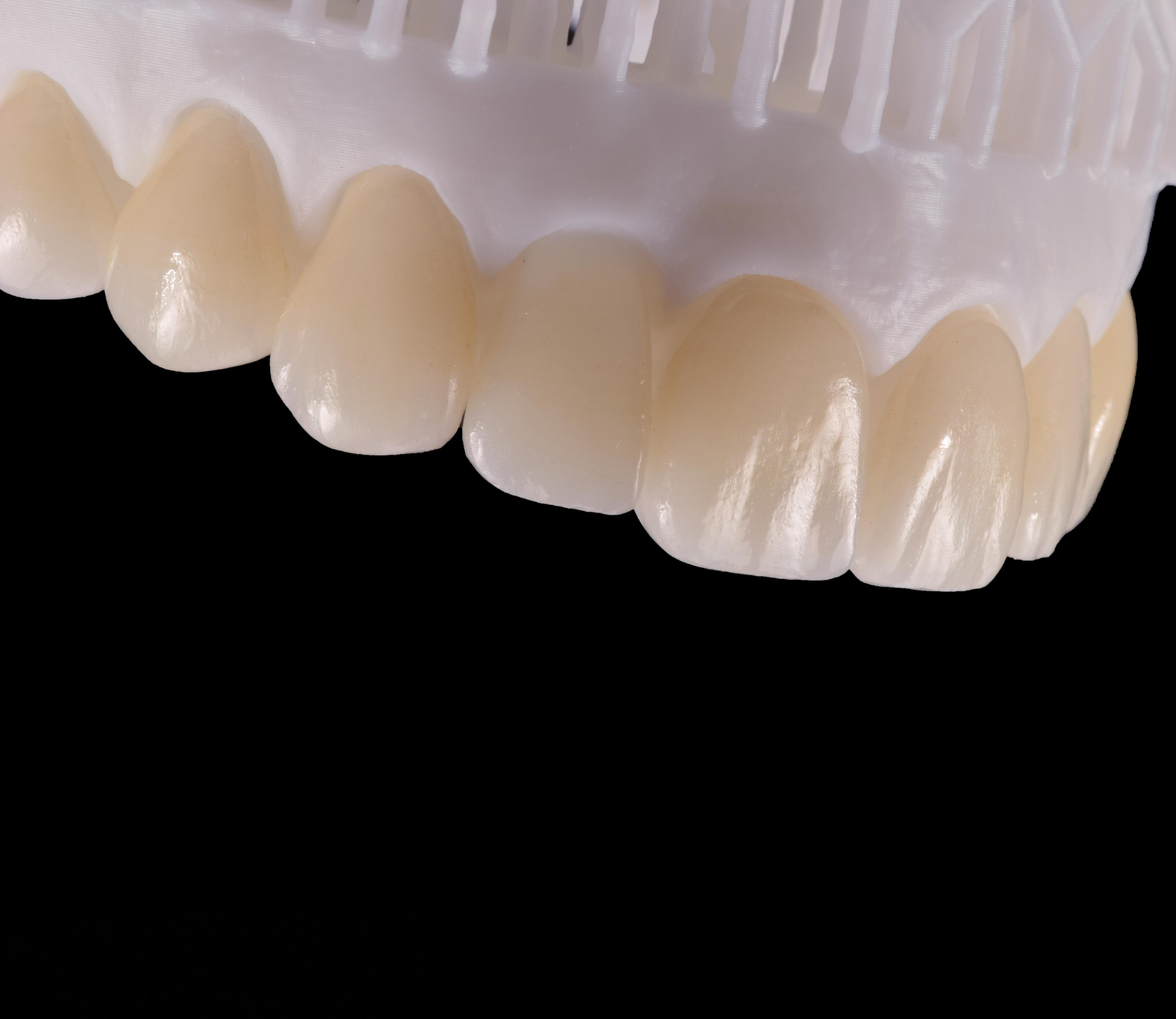 Detalle de trabajo protésico en Casal Laboratorio Dental Buenos Aires